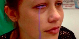 Model awaits surgery after eyeball tattoo goes extremely wrong