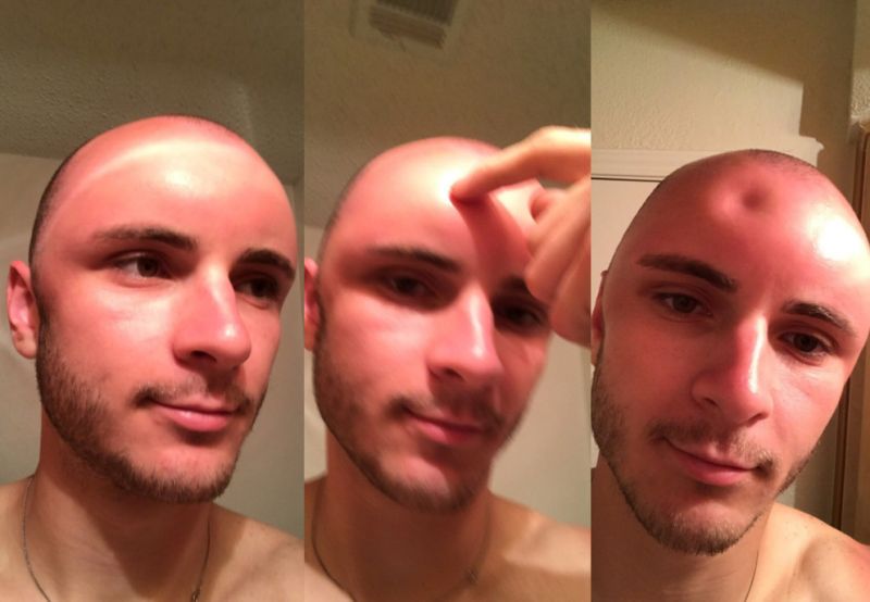 This man's sunburn was so severe it caused a dent in his head