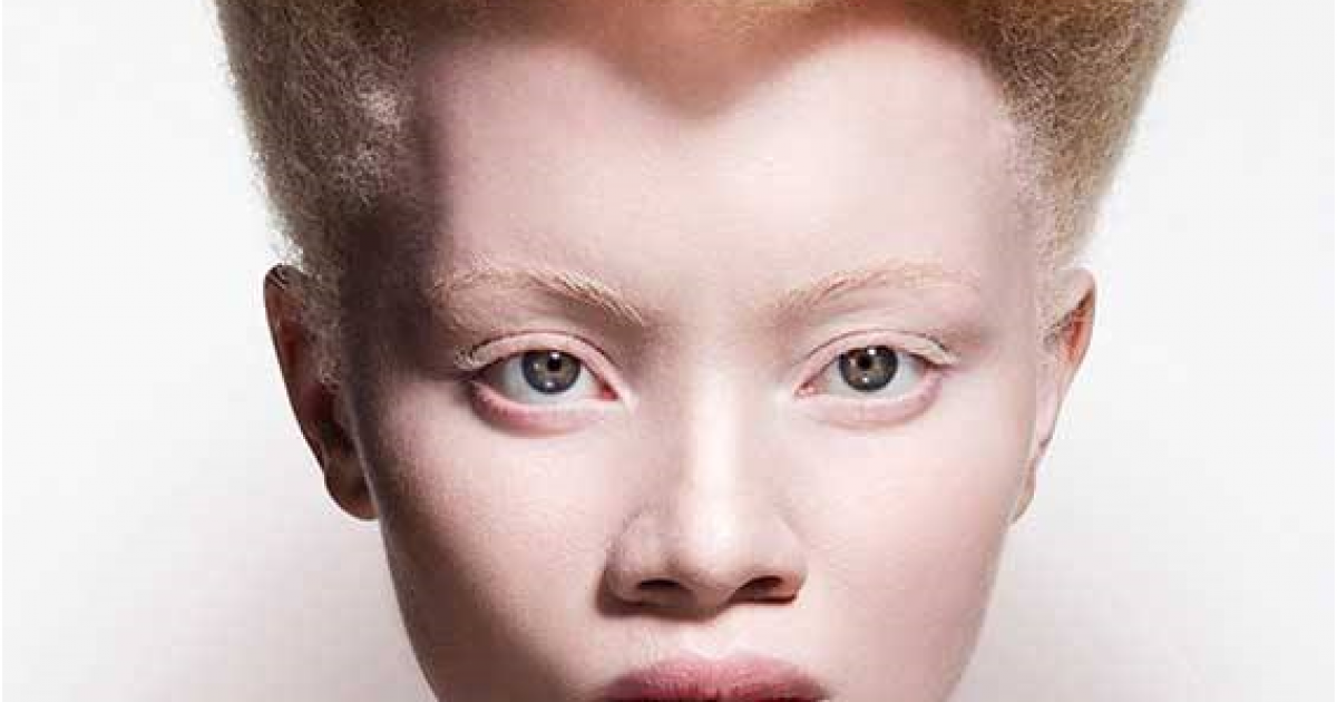 EU supports Albino Foundation with N70m