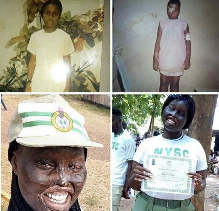 How My Uncle’s Wife Poured Acid On Me - Acid Survivor