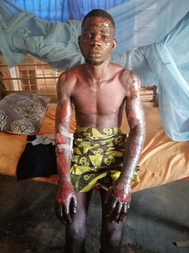 Tragedy As Girl Sets Boyfriend On Fire For Dumping Her